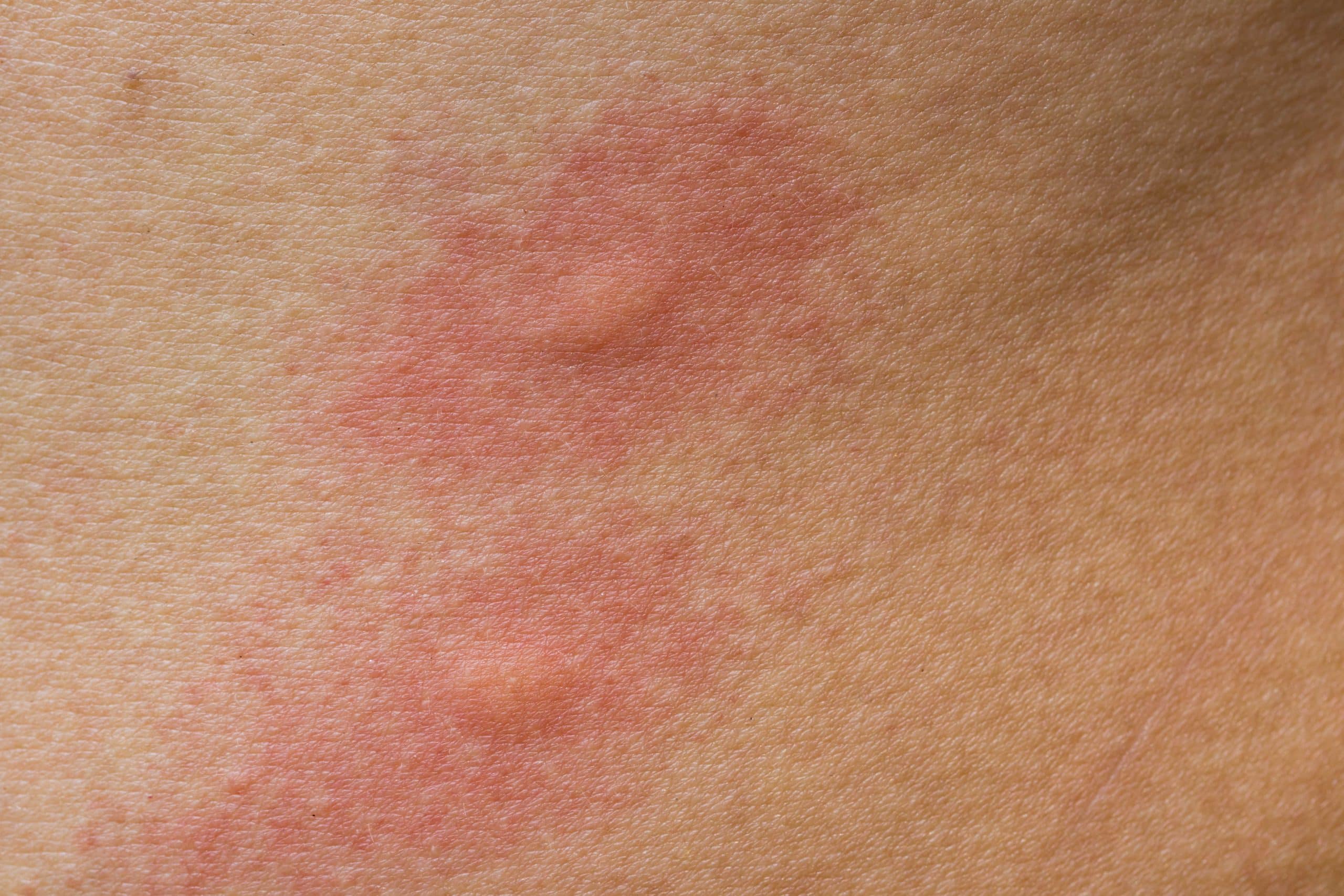 mosquito bite - mosquito infestation